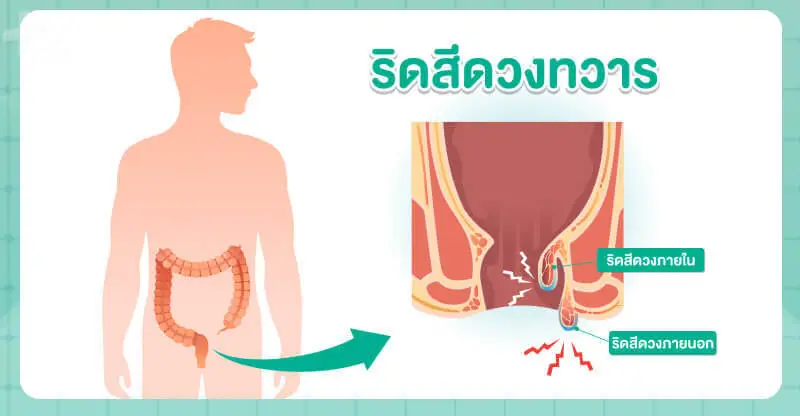 ริดสีดวงภายในและริดสีดวงภายนอก