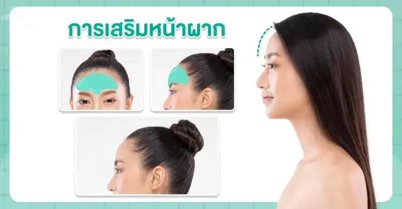 การเสริมหน้าผากด้วยซิลิโคน