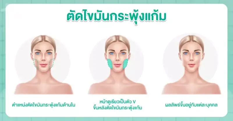 การตัดไขมันกระพุ้งแก้ม