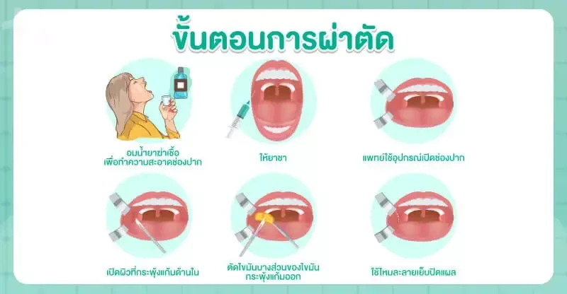 ขั้นตอนการตัดไขมันกระพุ้งแก้ม
