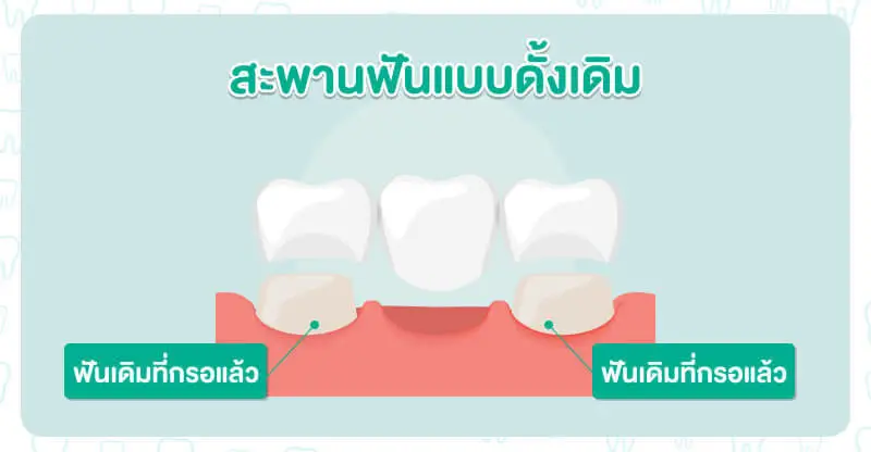 ตัวอย่างสะพานฟันแบบดั้งเดิม