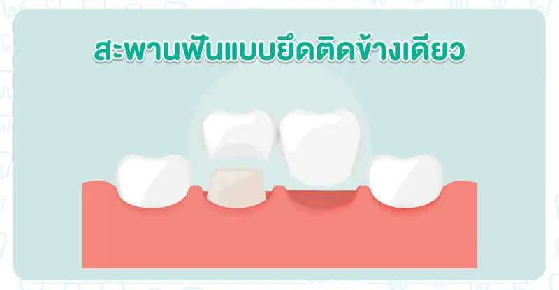 สะพานฟันแบบยึดติดข้างเดียว