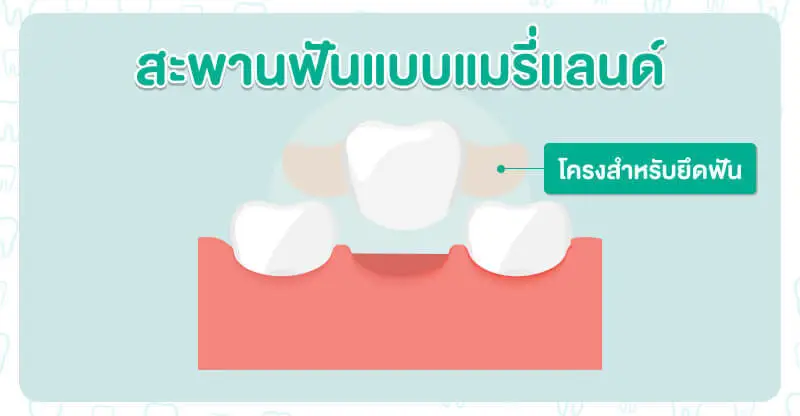 สะพานฟันแบบแมรี่แลนด์