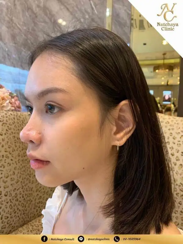 รีวิวเสริมจมูกจากคลินิก