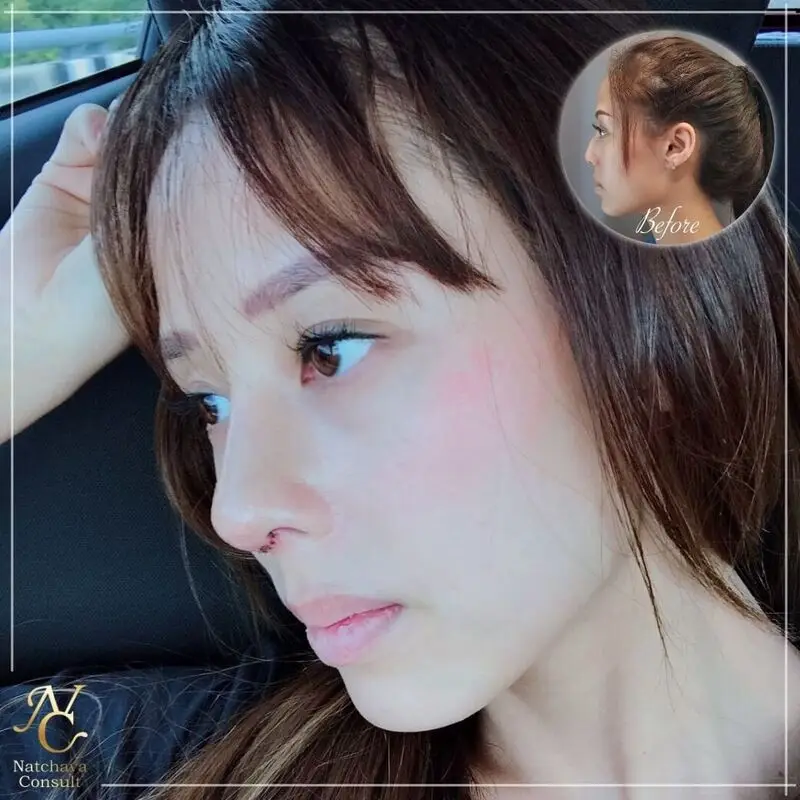รีวิวเสริมจมูกจากคลินิก