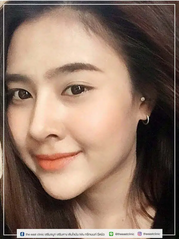 รีวิวเสริมจมูกจากคลินิก