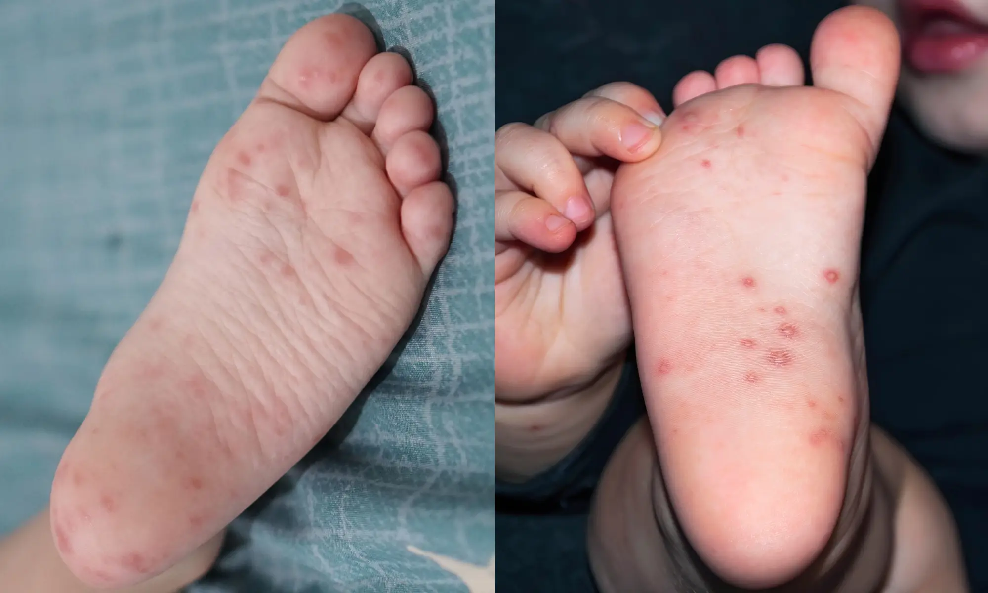 differences of hand foot mouth chickenpox disease definition