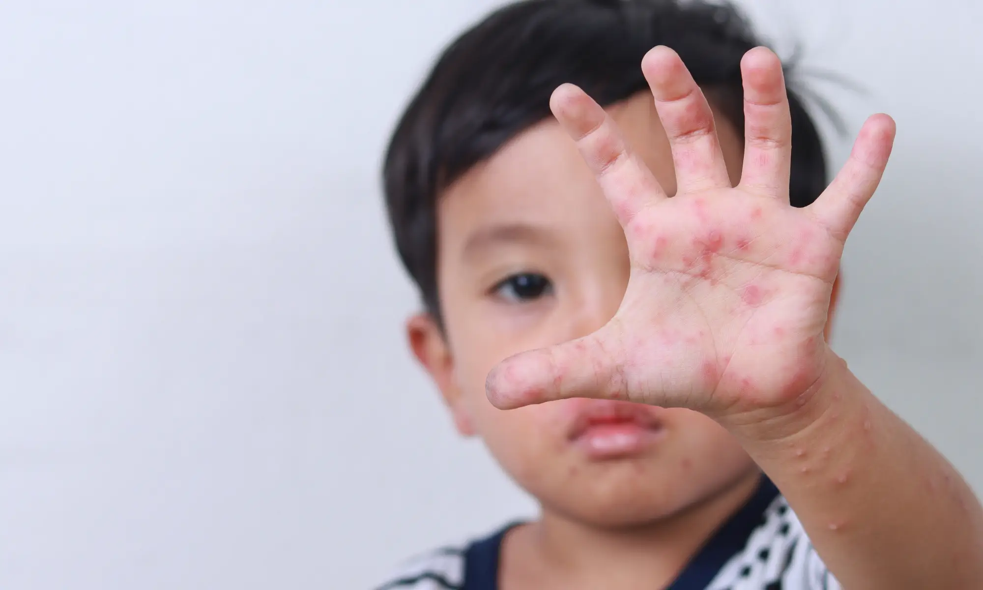 hfmd complications disease definition