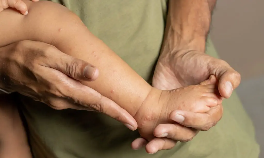 คู่มือดูแลโรคมือ เท้า ปากในเด็ก โรคพบบ่อยที่พ่อแม่ต้องรู้!