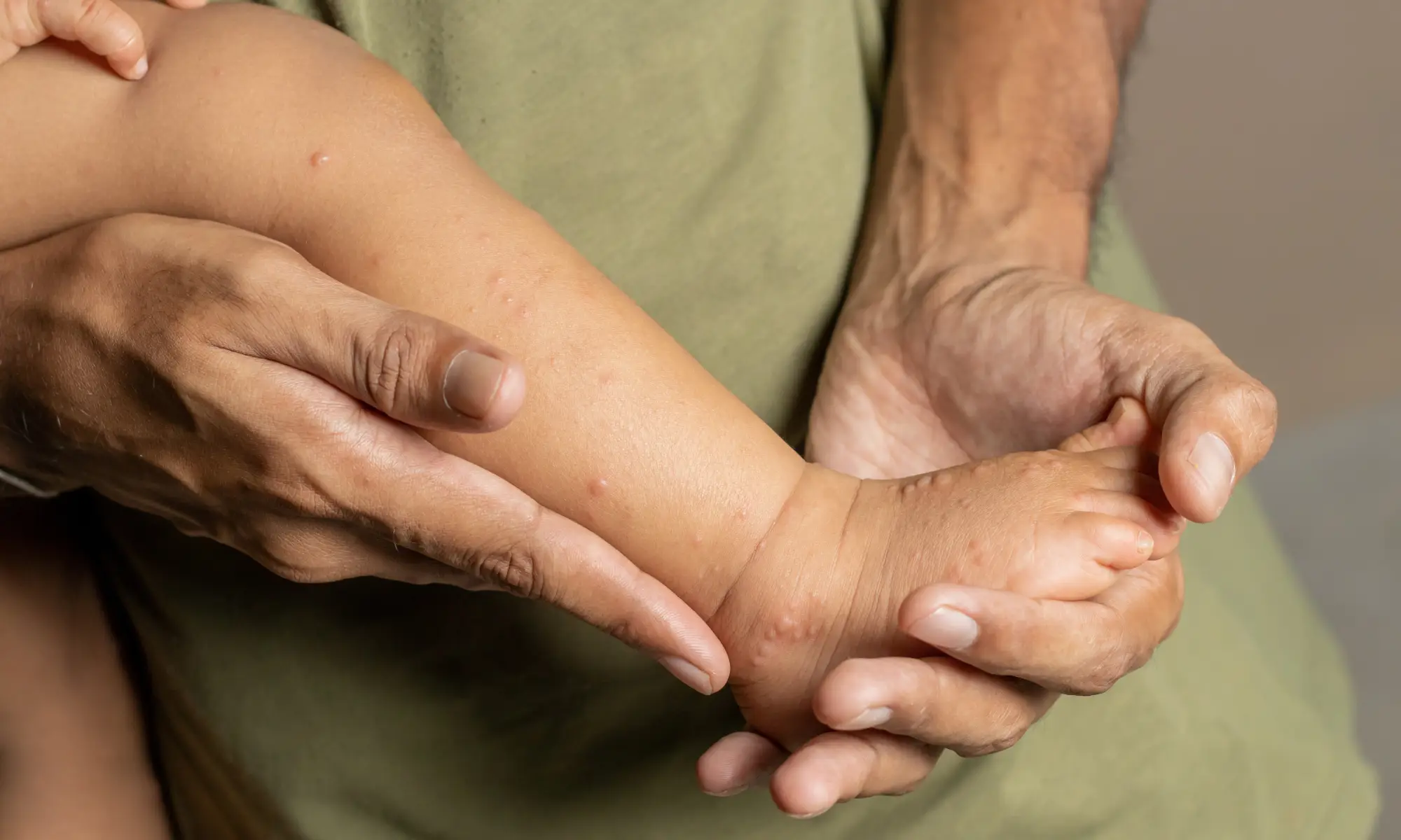 how to take care of hand foot mouth in kids treatment how to