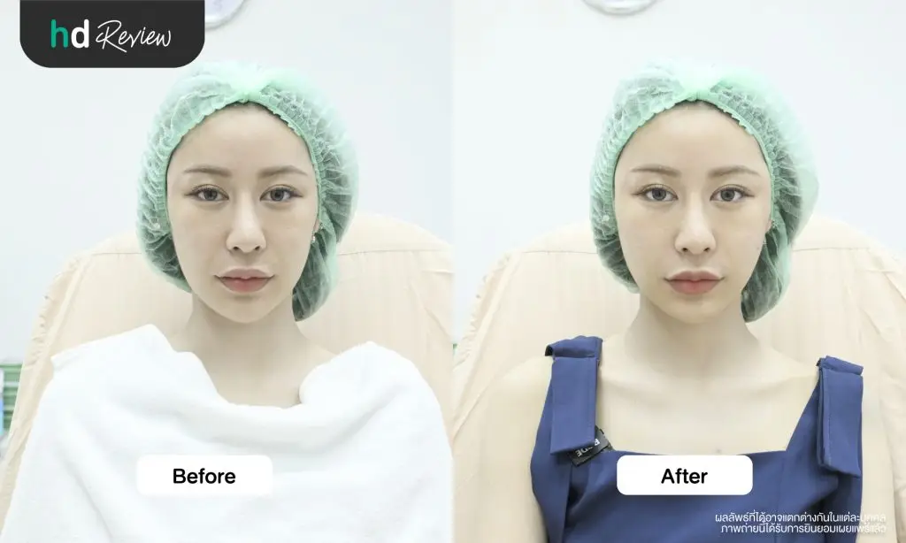 ผลลัพธ์หลังทำโปรแกรม Sculptra ด้านหน้า