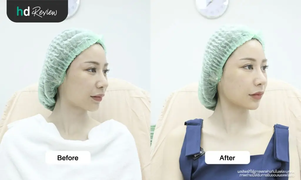 ผลลัพธ์หลังทำโปรแกรม Sculptra ด้านขวา