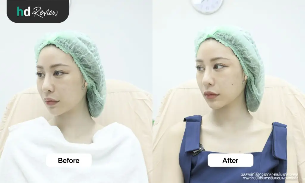 ผลลัพธ์หลังทำโปรแกรม Sculptra ด้านซ้าย