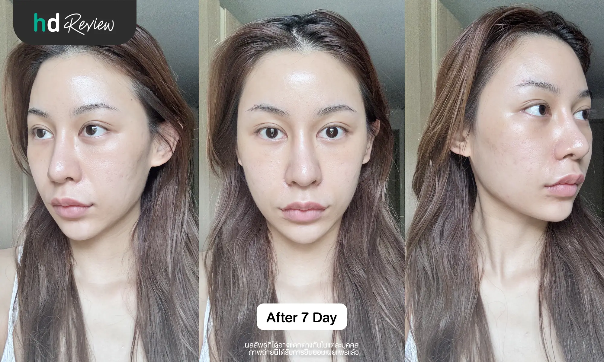 ผลลัพธ์หลังทำโปรแกรม Sculptra ครบ 7 วัน