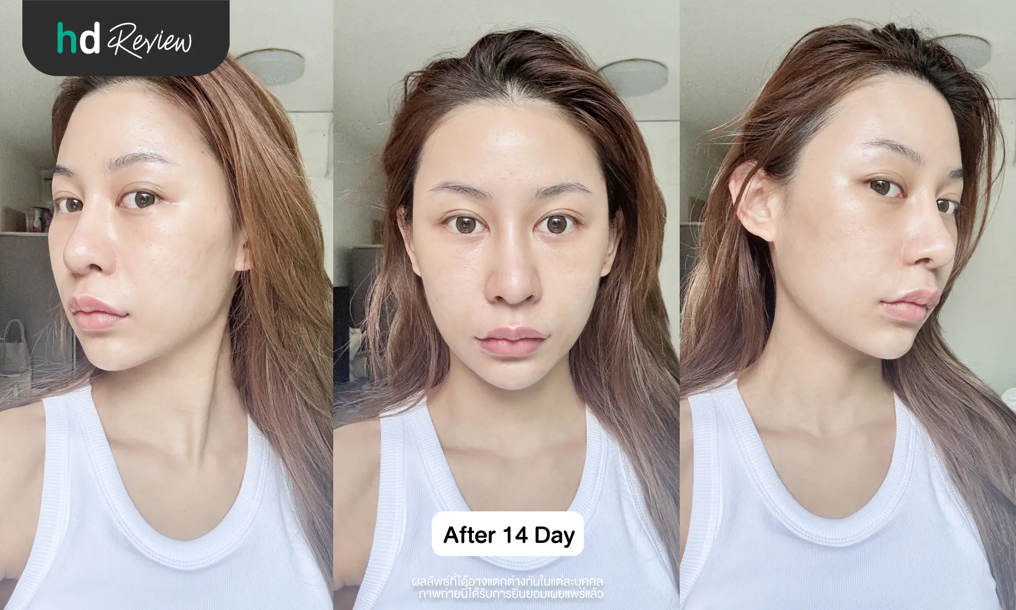 ผลลัพธ์หลังทำโปรแกรม Sculptra ครบ 14 วัน