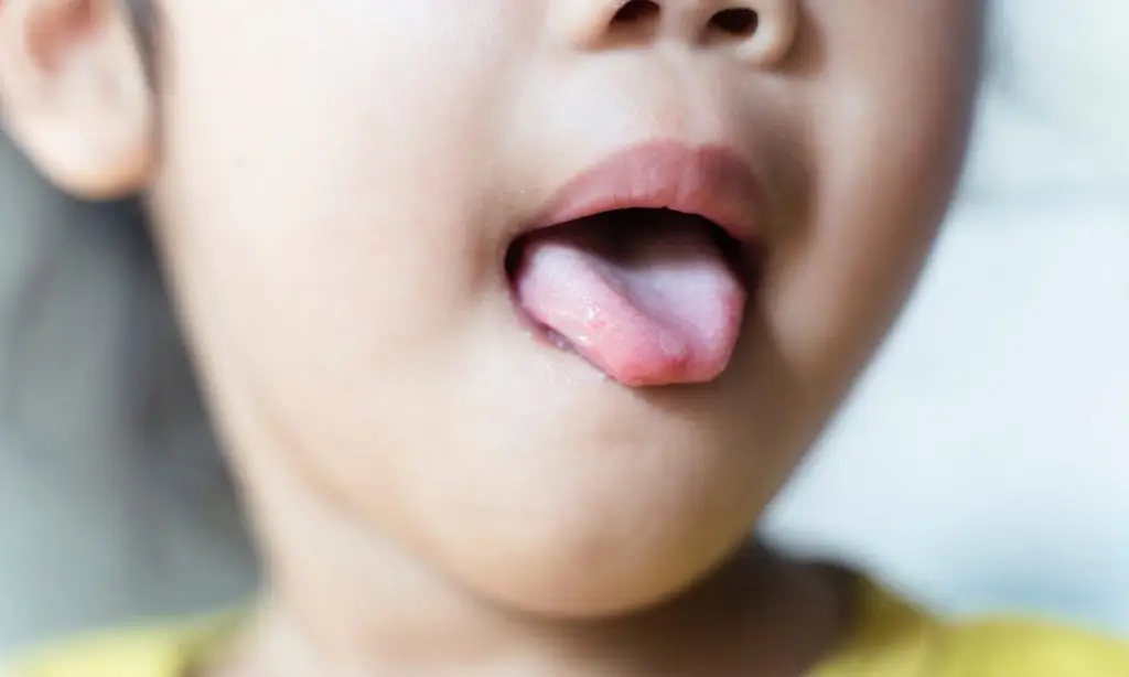รวมคำถามพบบ่อยของโรคมือ เท้า ปาก มีลูกเล็กต้องรู้