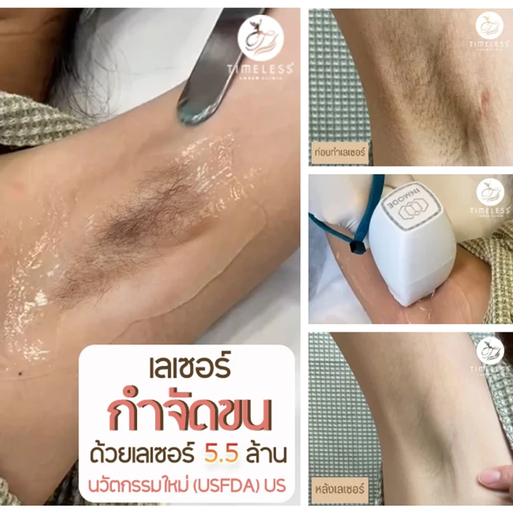 คอร์สเลเซอร์ Diode กำจัดขนรักแร้ 1 ปี 12 ครั้ง ผู้หญิงเท่านั้น ที่ Timeless Laser Clinic