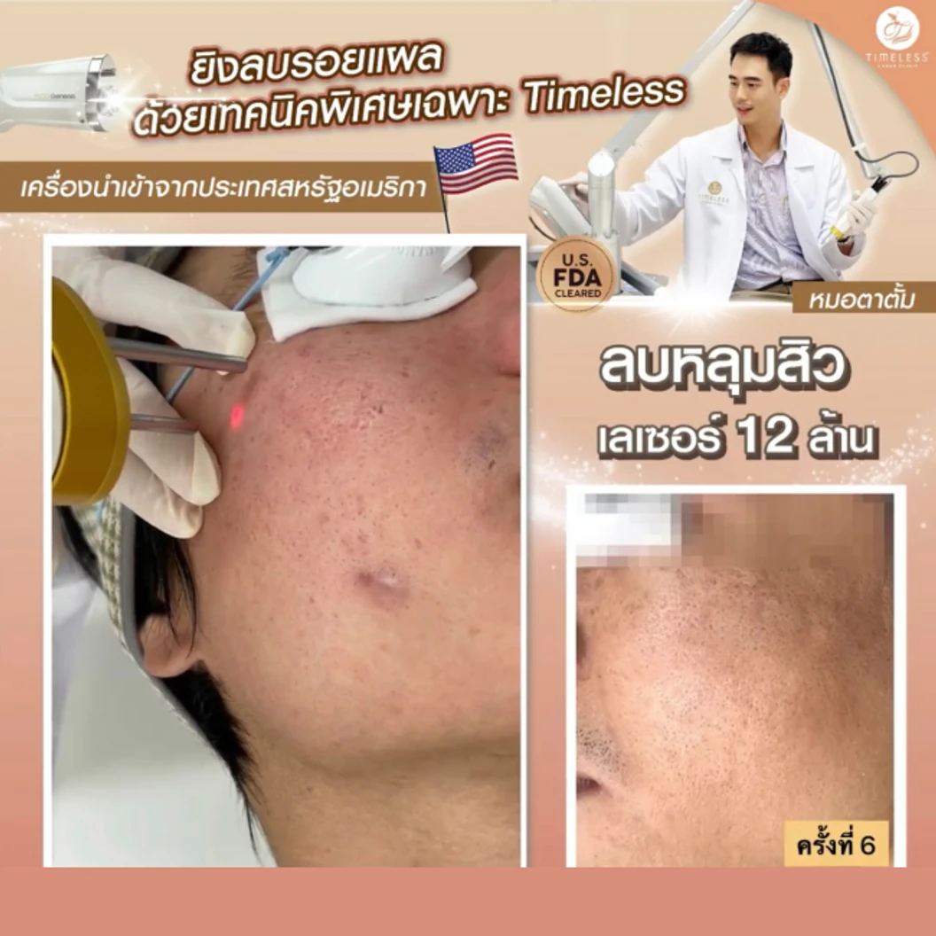 คอร์สเลเซอร์แก้ปัญหาผิวทั่วใบหน้า ด้วย Pico Enlighten จำนวน 1200 ช็อต เลือก 1 โหมด จาก 2 โหมด 10 ครั้ง ภายใน 1 ปี ที่ Timeless Laser Clinic