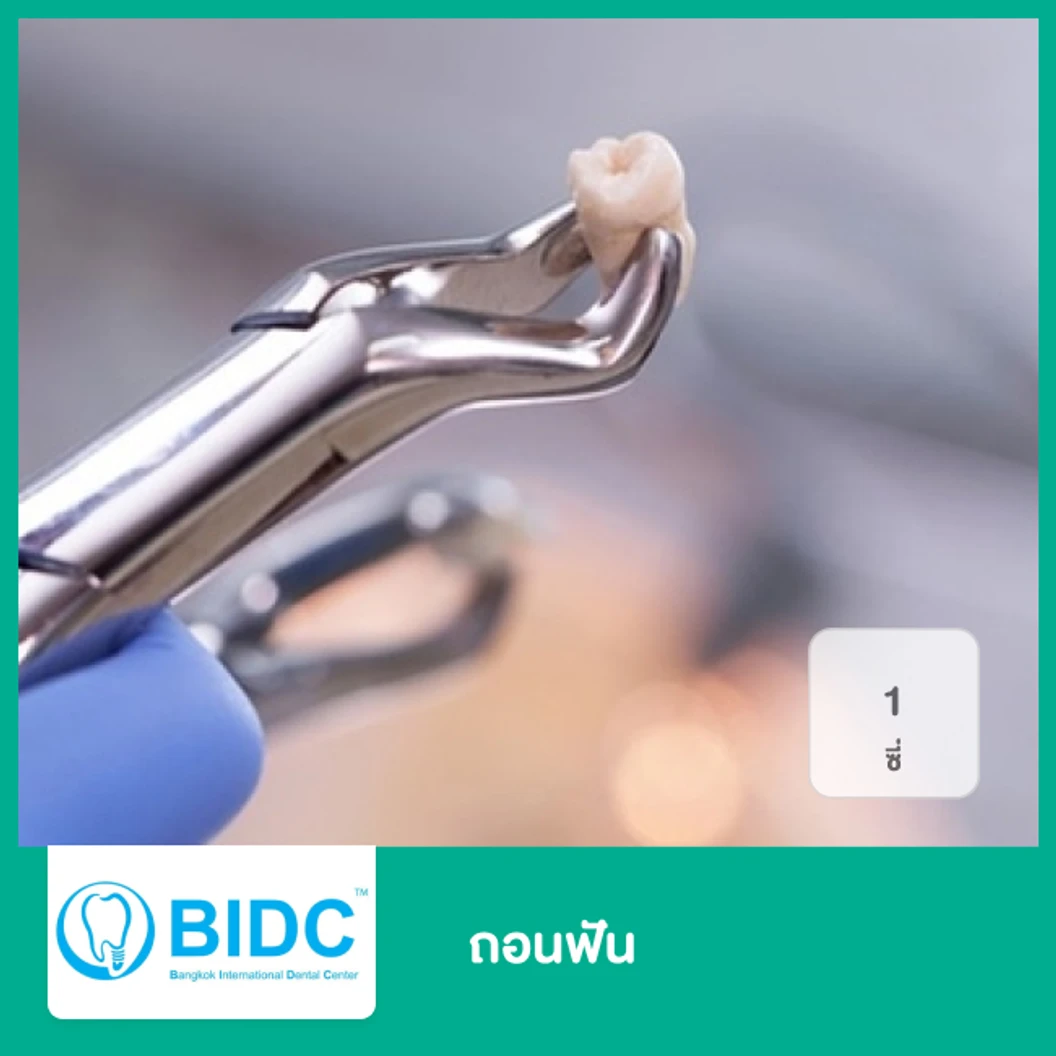 ถอนฟัน 1 ซี่  ที่ BIDC Dental Center BIDC