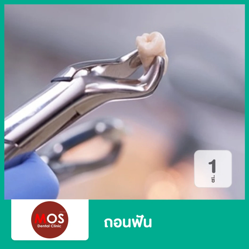 ถอนฟัน 1 ซี่ ที่ MOS Dental Clinic