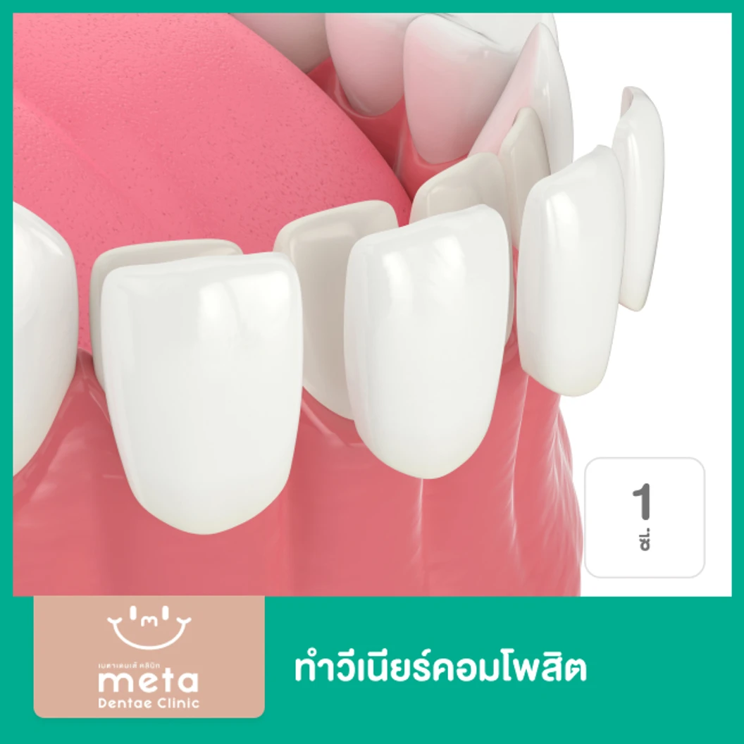 ทำวีเนียร์คอมโพสิต 1 ซี่ ที่ Meta Dentae Clinic