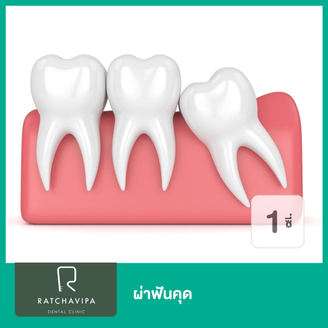 ผ่าฟันคุด 1 ซี่ ที่ Ratchavipa Dental Clinic คลินิกทันตกรรมรัชวิภา