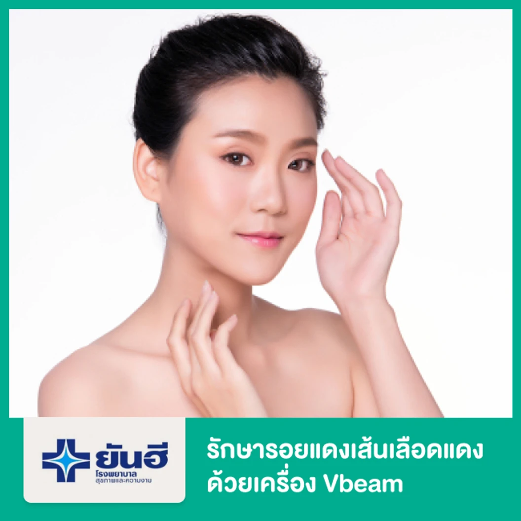 รักษารอยแดงเส้นเลือดแดง ด้วยเครื่อง Vbeam ที่ โรงพยาบาลยันฮี