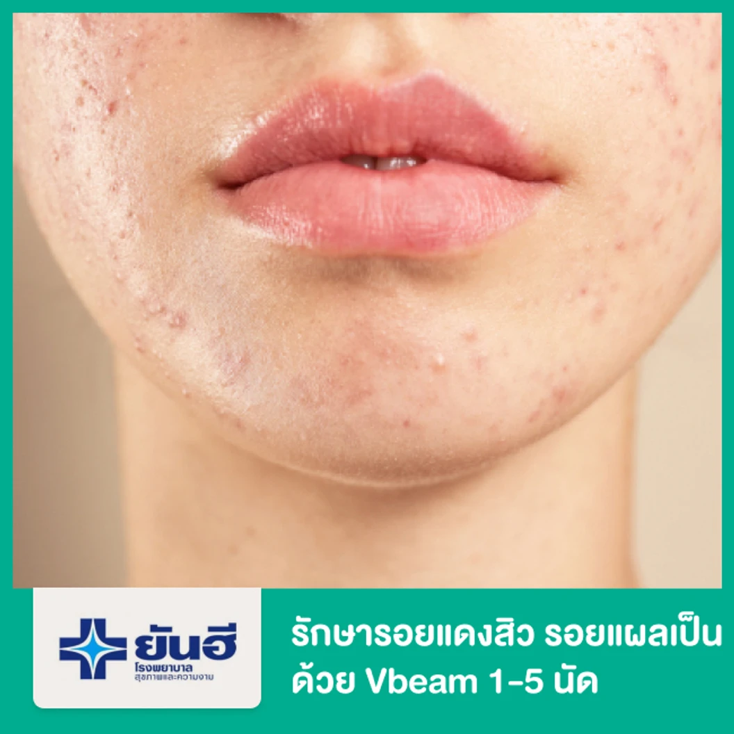 รักษารอยแดงจากสิว รอยแผลเป็น ด้วยเครื่อง Vbeam 1-5 ช็อตแรก ที่ โรงพยาบาลยันฮี