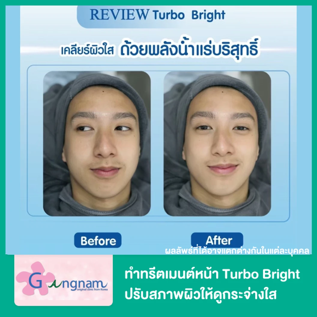 ทำทรีตเมนต์หน้า Turbo Bright ปรับสภาพผิวให้ดูกระจ่างใส 1 ครั้ง ที่ Gangnam Clinic