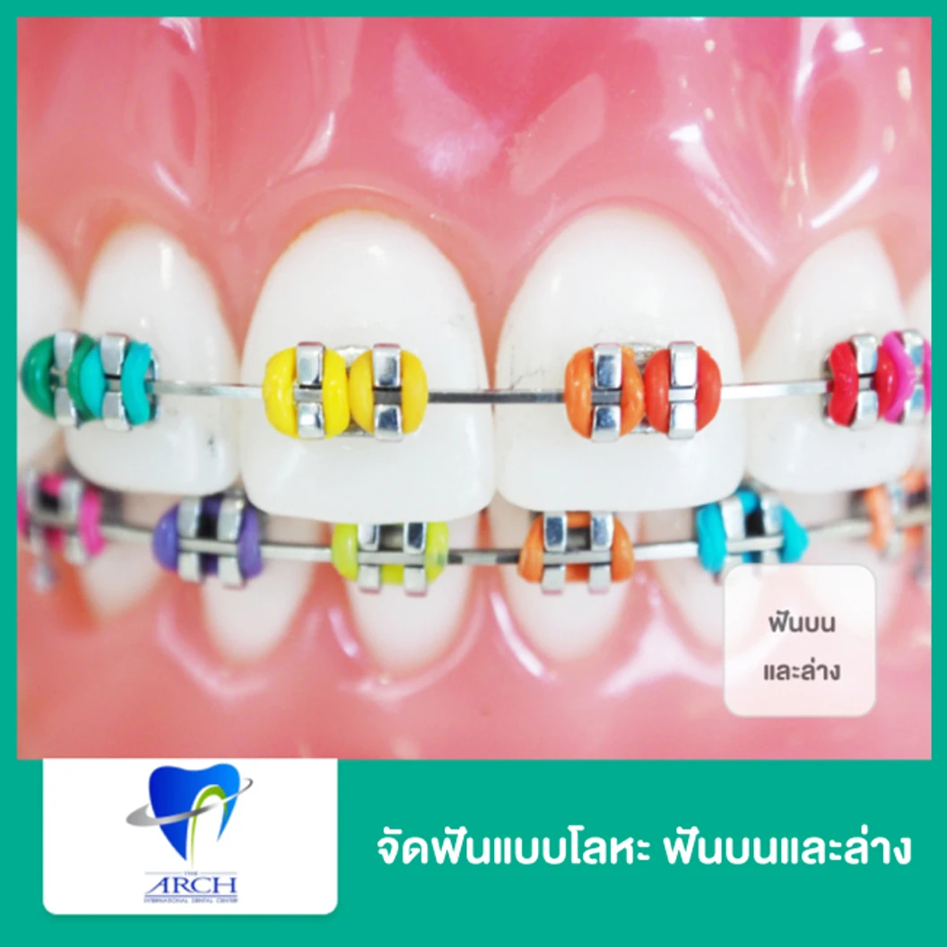 จัดฟันแบบโลหะ ฟันบนและล่าง ที่ The ARCH Dental Center ศูนย์ทันตกรรมดิอาร์ช