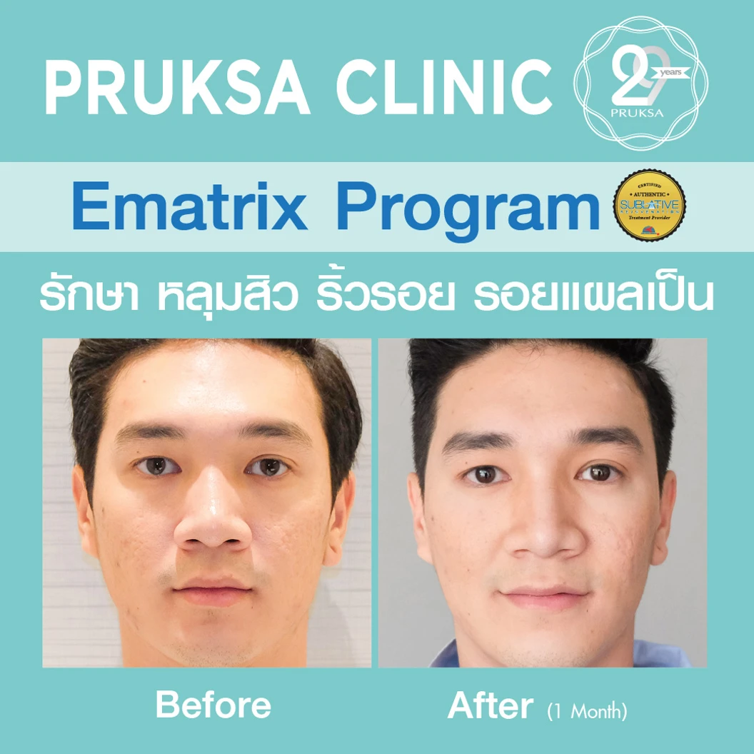 เลเซอร์ E-Matrix แก้ปัญหาหลุมสิว ผิวขรุขระ รูขุมขนกว้าง 100 ช็อต 1 ครั้ง ที่ พฤกษาคลินิก Pruksa Clinic
