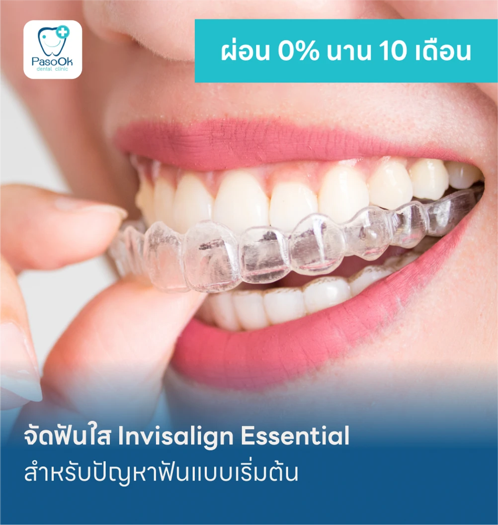 จัดฟันใส Invisalign Essential แพ็กเกจ HDcare Lite ที่ คลินิกทันตกรรมพาสุข Pasook Dental Clinic