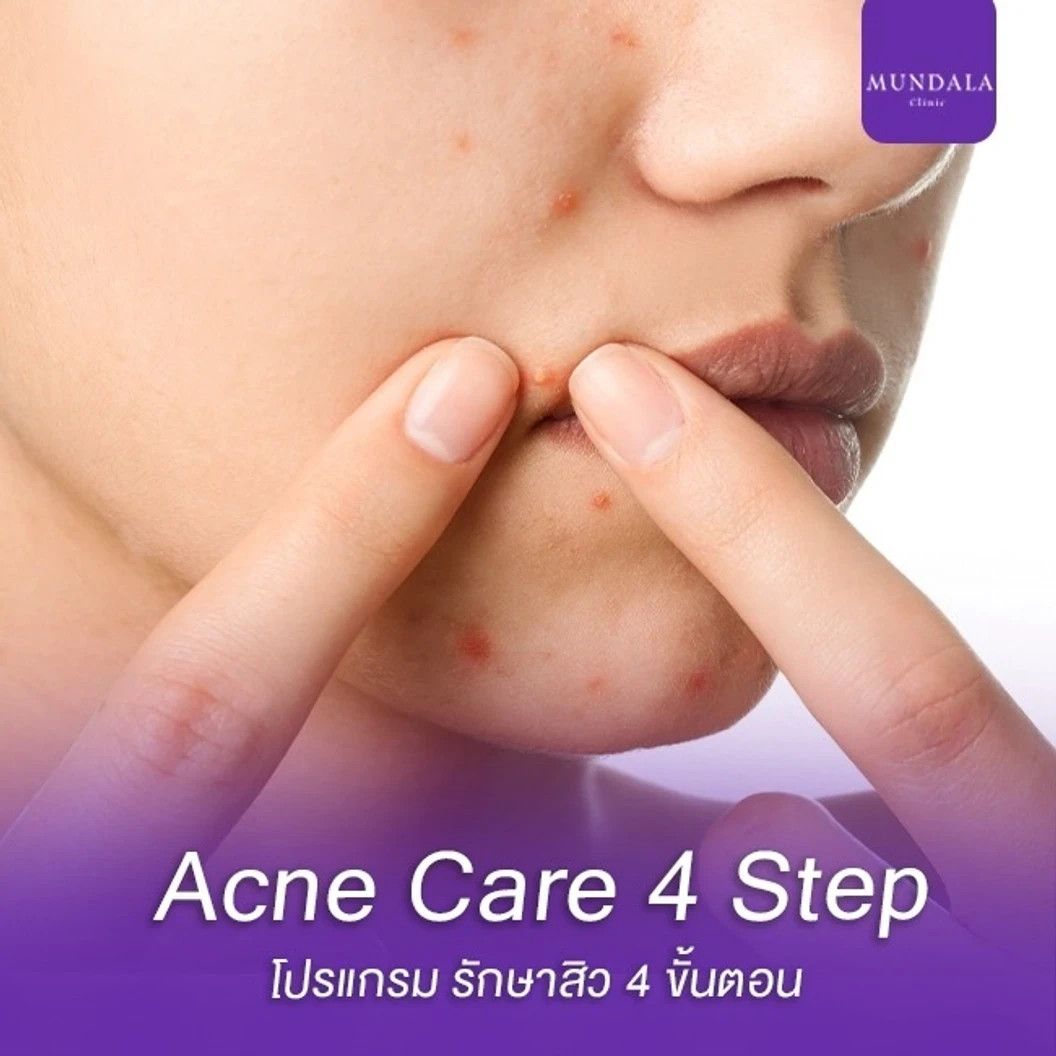 รักษาสิวหน้า Acne Care 4 Step 4 ขั้นตอน ที่ Mundala Clinic