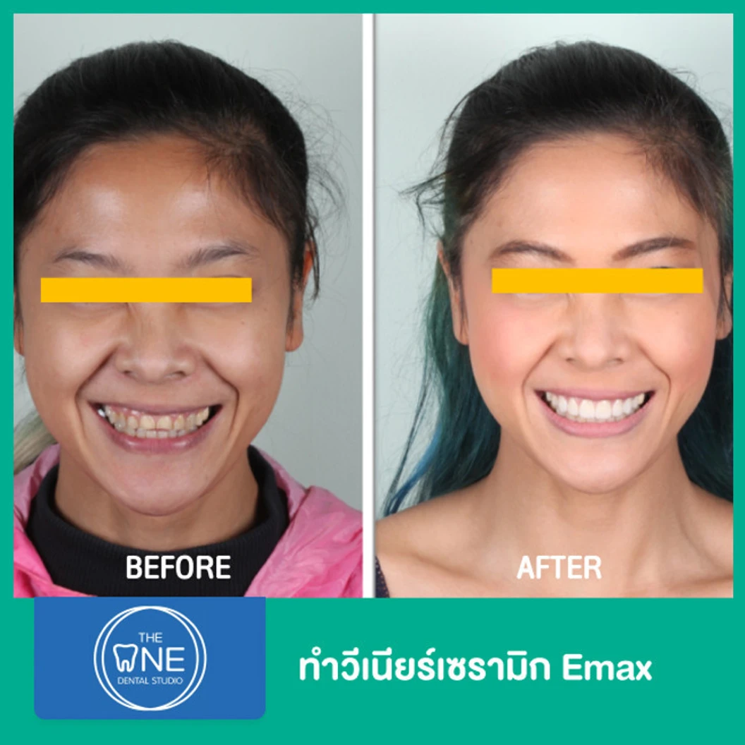 ทำวีเนียร์เซรามิก Emax 4 ซี่ ขึ้นไป ราคาต่อซี่ ที่ The One Dental Studio