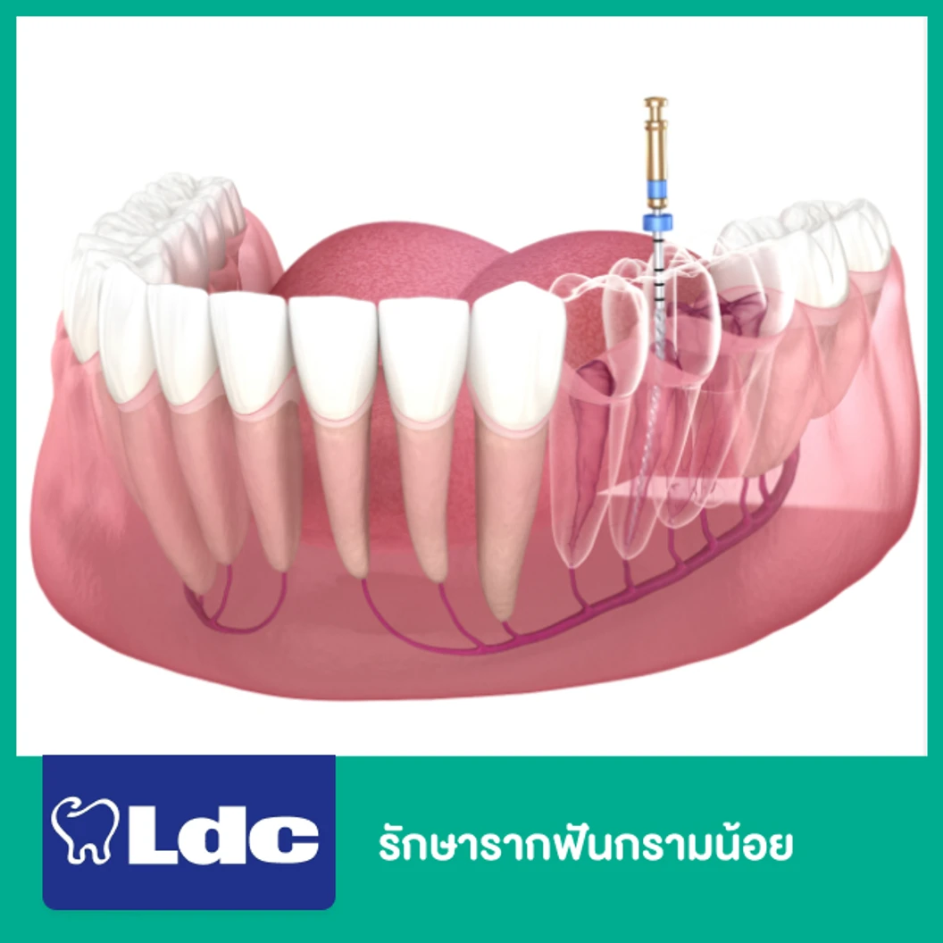 รักษารากฟันกรามน้อย  ที่ LDC Dental