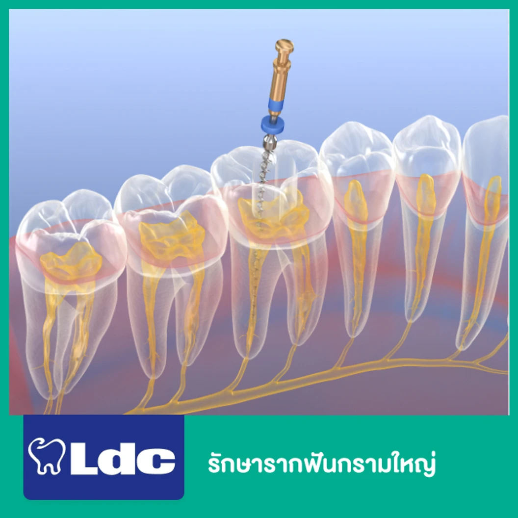 รักษารากฟันกรามใหญ่ ที่ LDC Dental