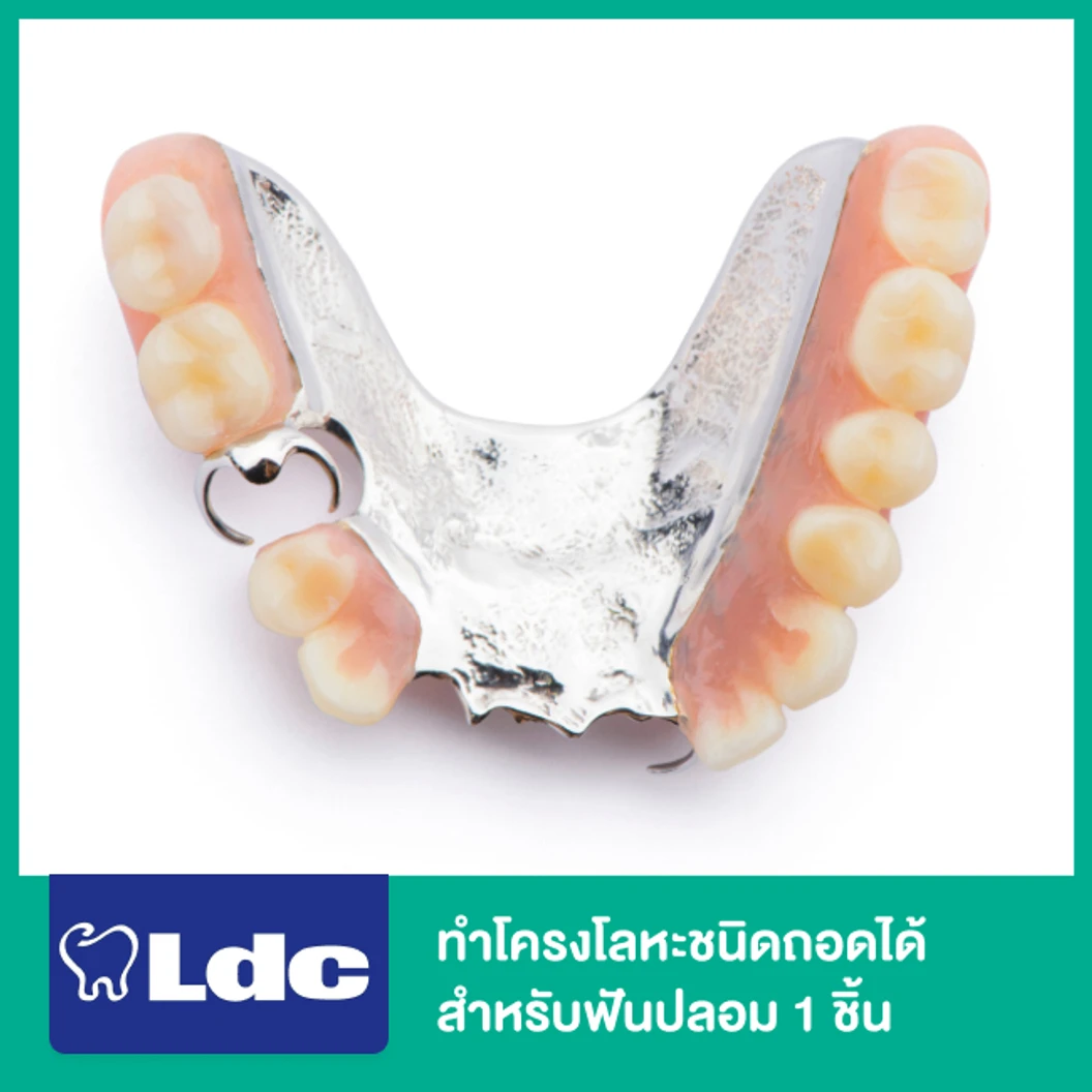 ทำโครงโลหะชนิดถอดได้ สำหรับฟันปลอม 1 ชิ้น ที่ LDC Dental