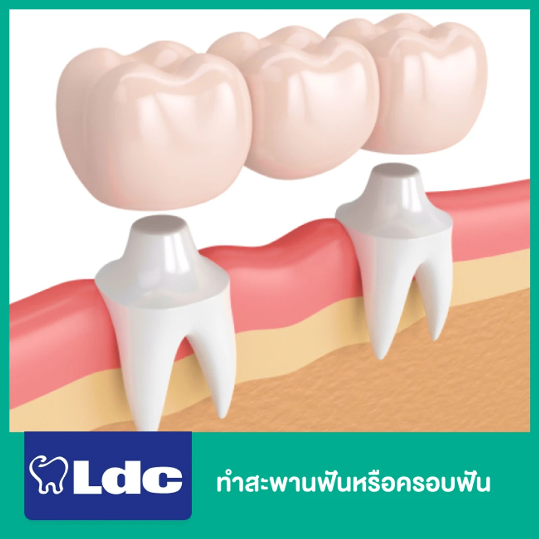 ทำสะพานฟันหรือครอบฟัน 1 ซี่ ที่ LDC Dental