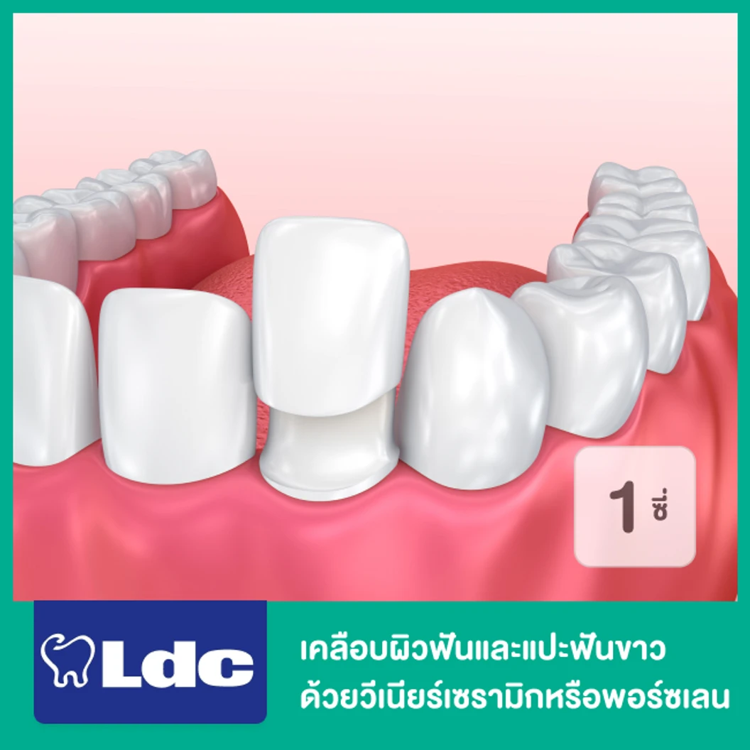 เคลือบผิวฟันและแปะฟันขาว ด้วยวีเนียร์เซรามิกหรือพอร์ซเลน 1 ซี่ ที่ LDC Dental