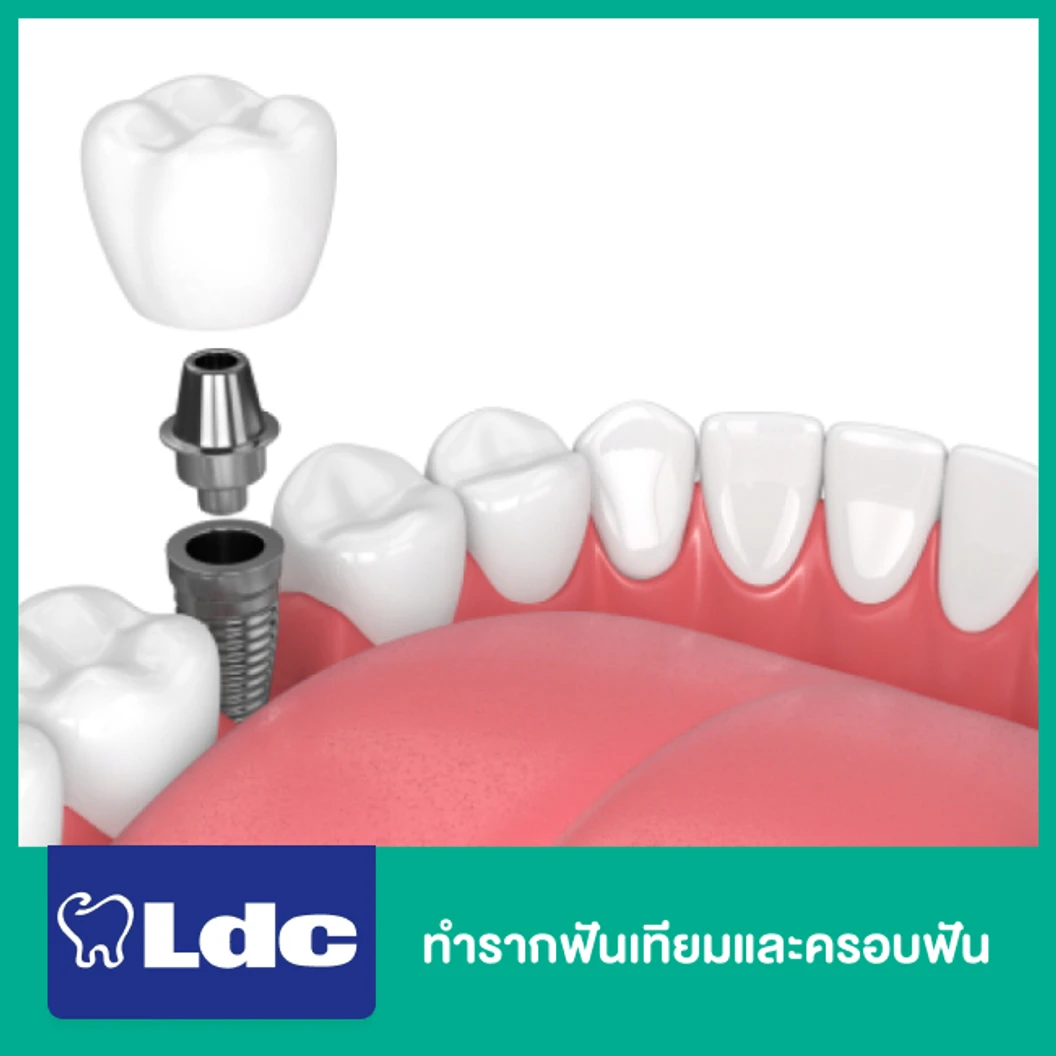 ทำรากฟันเทียมและครอบฟัน ที่ LDC Dental