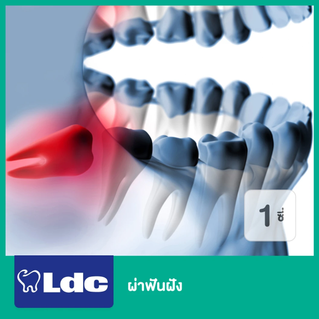 ผ่าฟันฝัง 1 ซี่ ที่ LDC Dental