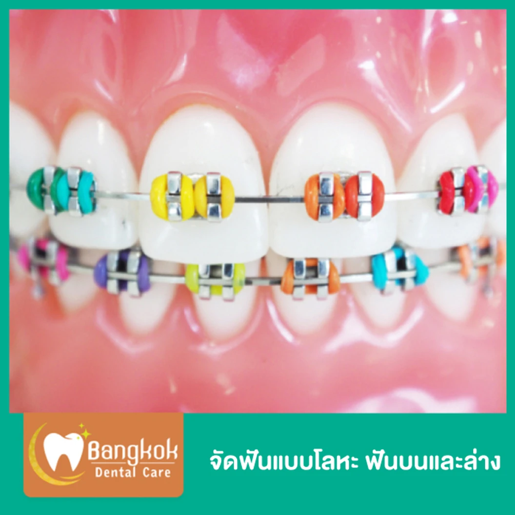 จัดฟันแบบโลหะ ฟันบนและล่าง ที่ Bangkok Dental Care
