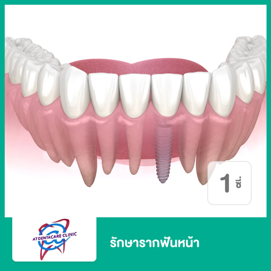 รักษารากฟันหน้า 1 ซี่ ที่ แอทเดนต้าแคร์ คลินิกทันตกรรม