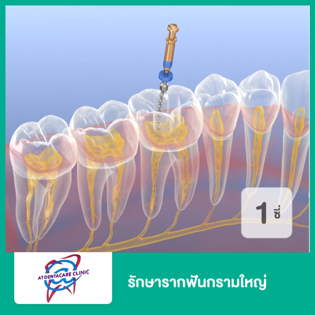 รักษารากฟันกรามใหญ่ 1 ซี่ ที่ แอทเดนต้าแคร์ คลินิกทันตกรรม