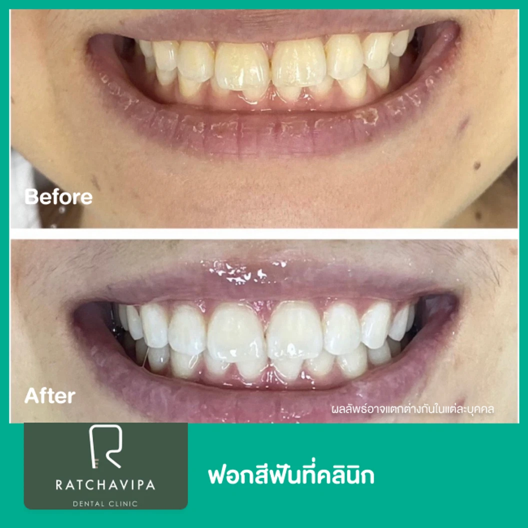 ฟอกสีฟันที่คลินิก ด้วยระบบ Zoom ที่ Ratchavipa Dental Clinic คลินิกทันตกรรมรัชวิภา