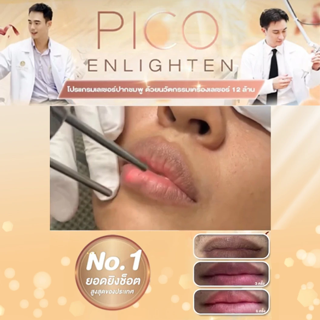 เลเซอร์ลดปากดำ ปากคล้ำ ด้วยเครื่อง Pico Enlighten 300 ซ็อต 1 ครั้ง ที่ Timeless Laser Clinic
