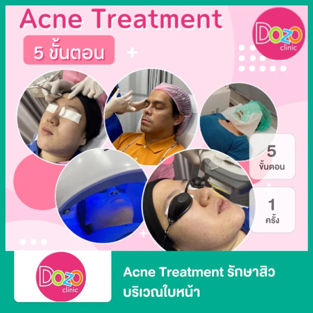 Acne Treatment รักษาสิว บริเวณใบหน้า 5 ขั้นตอน 1 ครั้ง ที่ Dozo Clinic