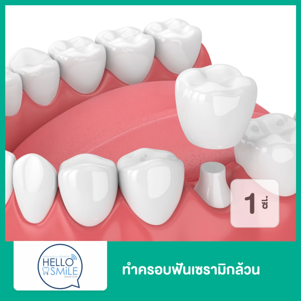 ทำครอบฟันเซรามิกล้วน สำหรับฟัน 1 ซี่ ที่ Hello Smile Dental Clinic
