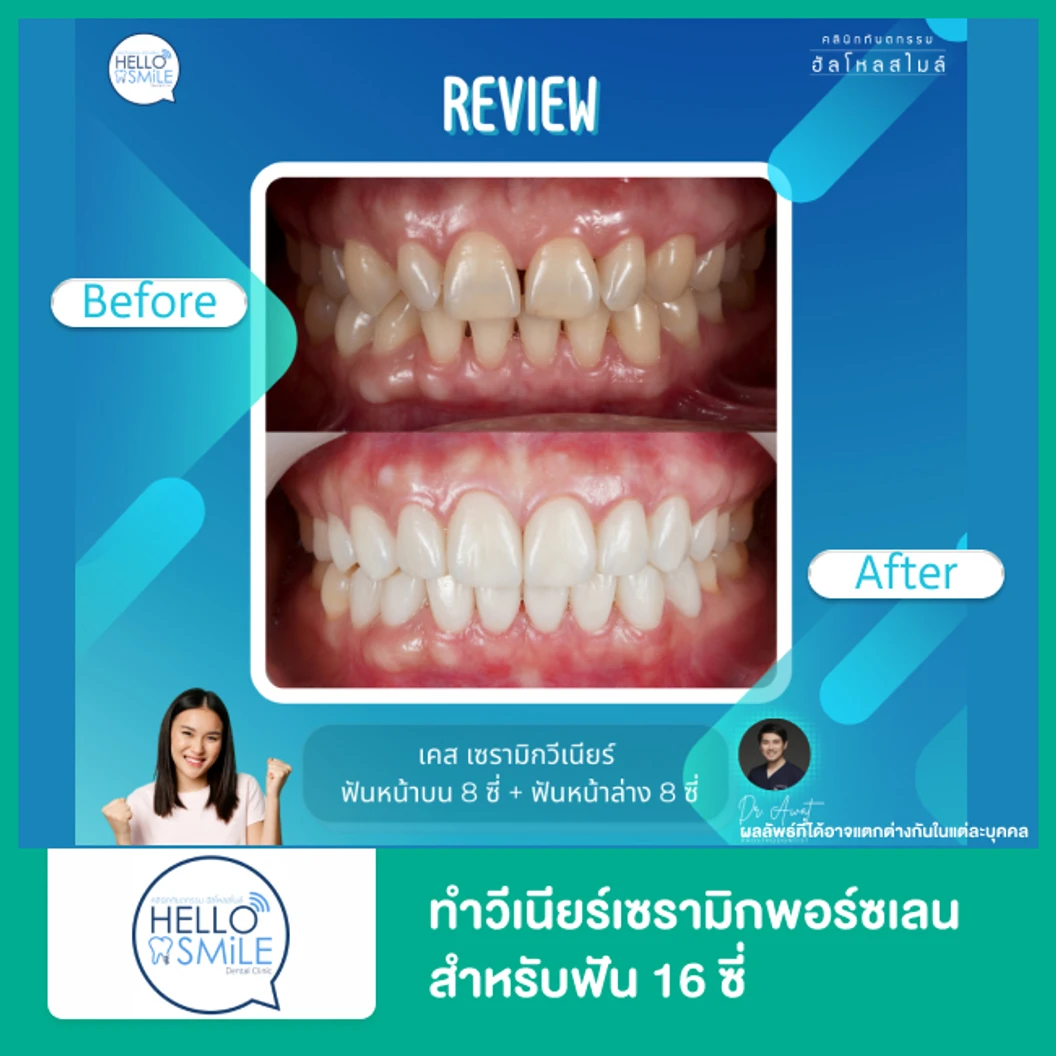 ทำวีเนียร์เซรามิกพอร์ซเลน สำหรับฟัน 16 ซี่ ที่ Hello Smile Dental Clinic