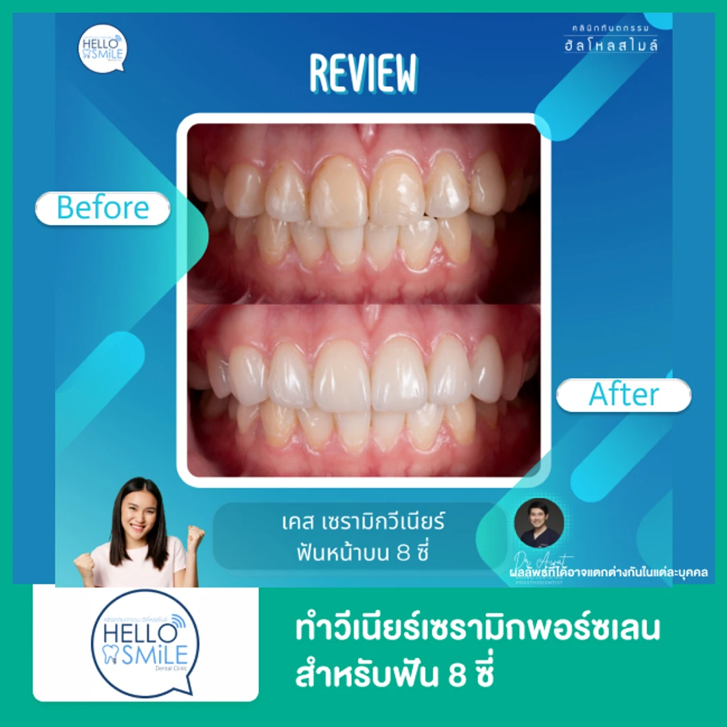 ทำวีเนียร์เซรามิกพอร์ซเลน สำหรับฟัน 8 ซี่ ที่ Hello Smile Dental Clinic
